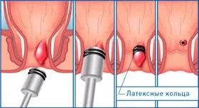 Латексное лигирование