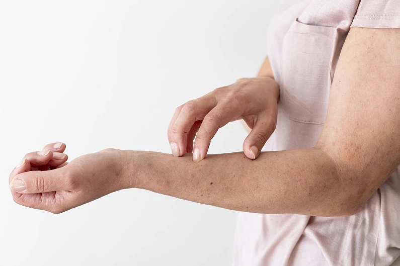 Аллергия на солнце и не только: чем опасны аллергические реакции?